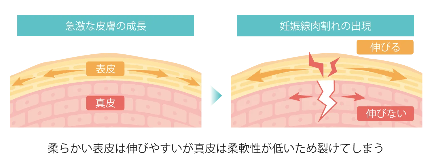 ストレッチマーク