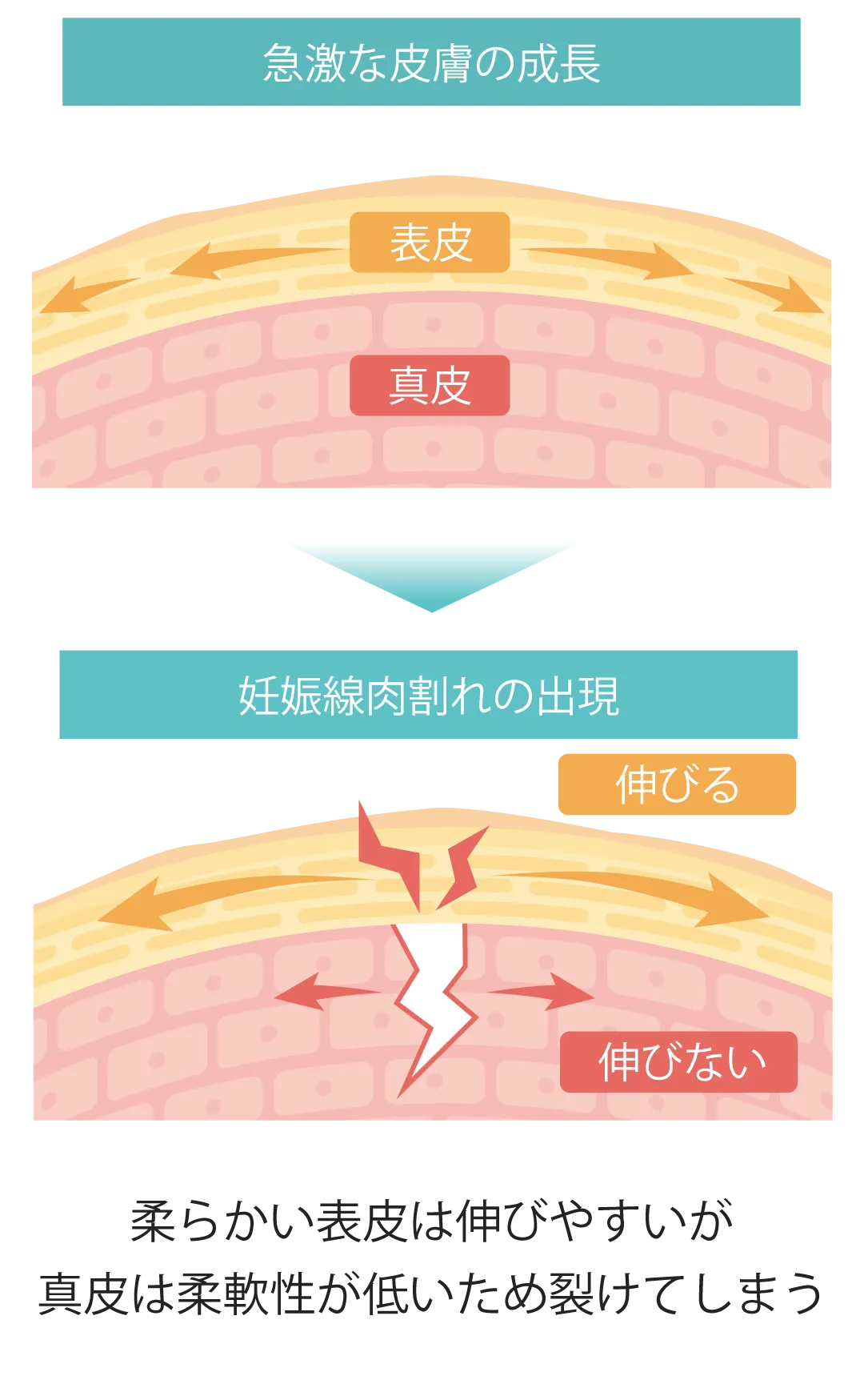 ストレッチマーク